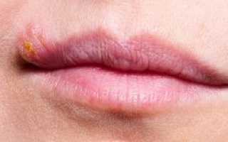 Как избавиться от шрама на губе после герпеса?