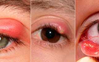 Простуда на глазах – как уберечь красоту и зрение?