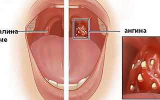 Что собой представляют миндалины в горле, воспаление миндалин