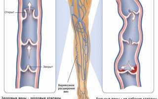 Обзор консервативных и хирургических методов лечения варикоза на ногах