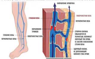 Острый и хронический тромбофлебит нижних конечностей: симптомы, лечение и профилактика