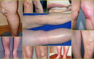 Причины, симптомы и лечение тромбоза глубоких вен нижних конечностей