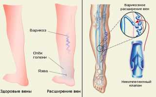 Применение венотоников при варикозе и отеках ног: кремы, гели, таблетки, обзор отзывов