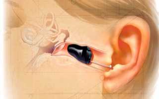 Особенности внутриушных слуховых аппаратов