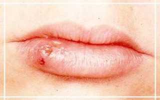 Причины частого герпеса на губах
