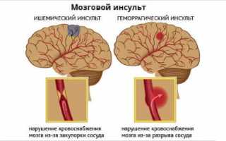 Лечение инсульта сосновыми шишками: народные рецепты