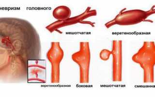 Причины возникновения, симптомы, лечение и последствия аневризмы головного мозга