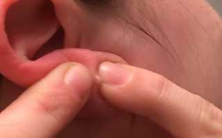 Уплотнение в мочке уха в виде шарика: что это и как лечить