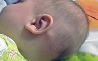 Как лечить воспаление лимфоузлов за ухом?