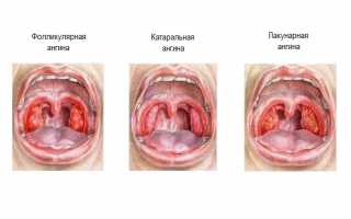 Как выглядит ангина и в чем ее опасность?