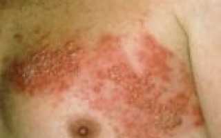 Герпесные высыпания на кожных покровах: причины появления и их лечение
